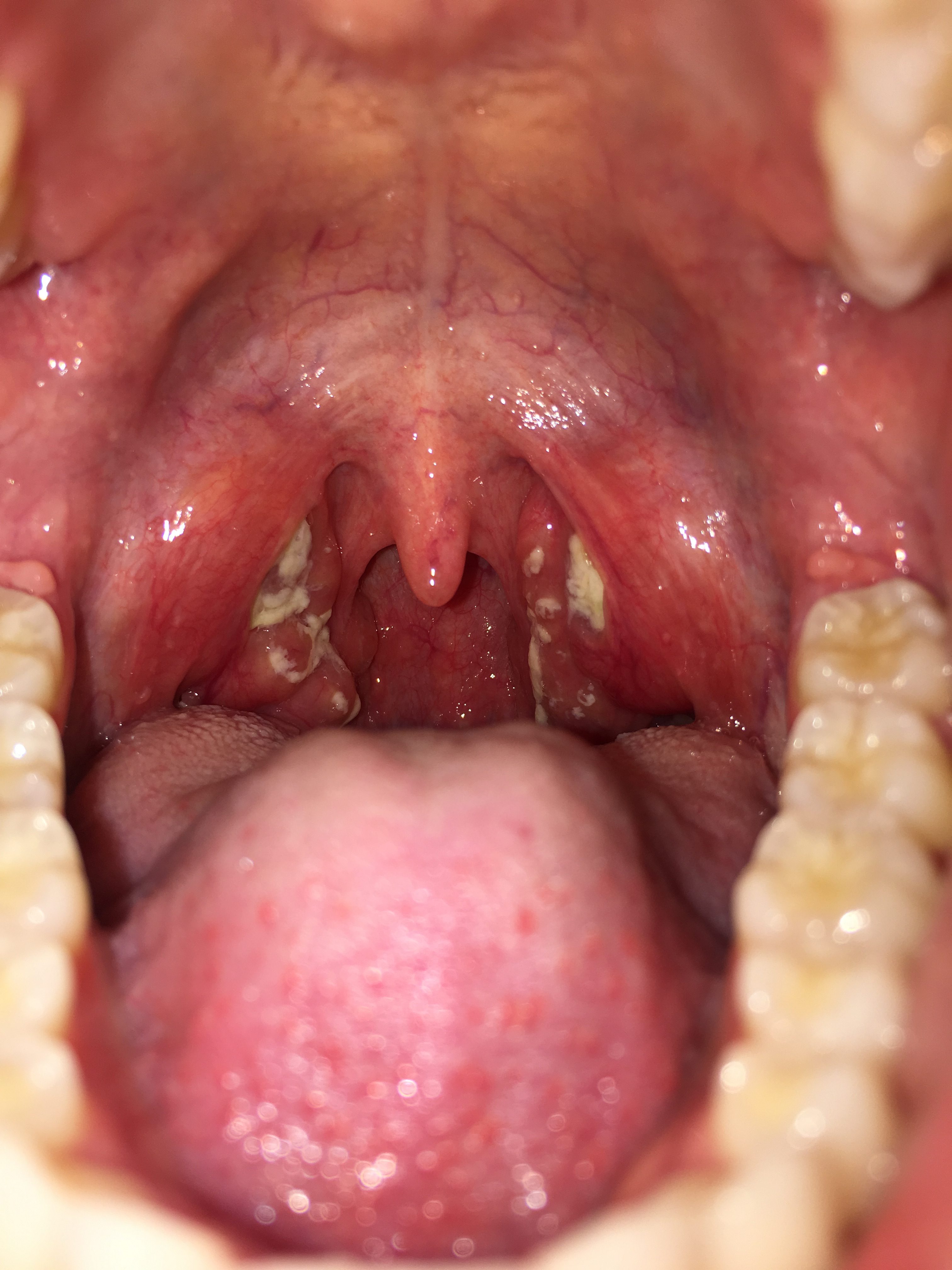 mononucleosis throat