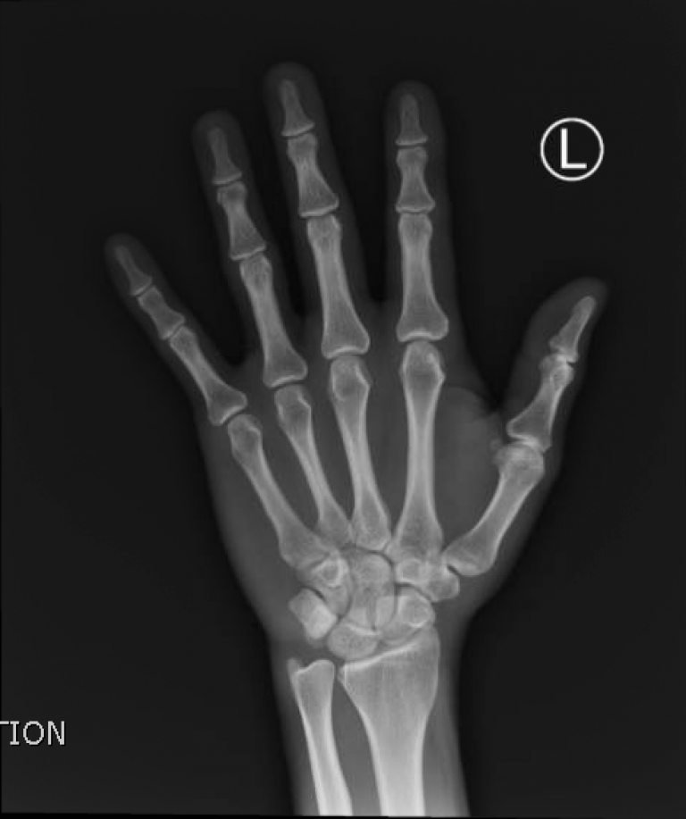 Stingray Hand XRay JETem 2017 - JETem