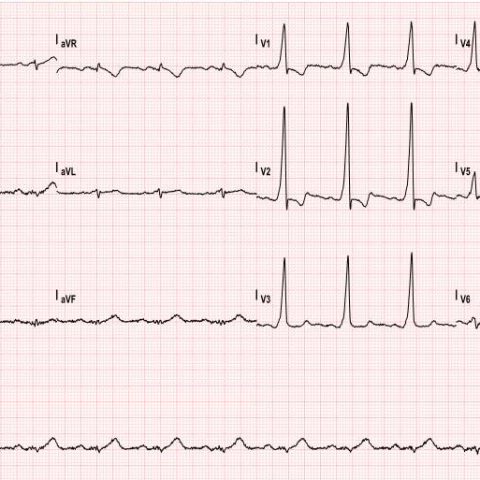 Asymptomatic Wolff-Parkinson-White Syndrome: Incidental EKG - JETem