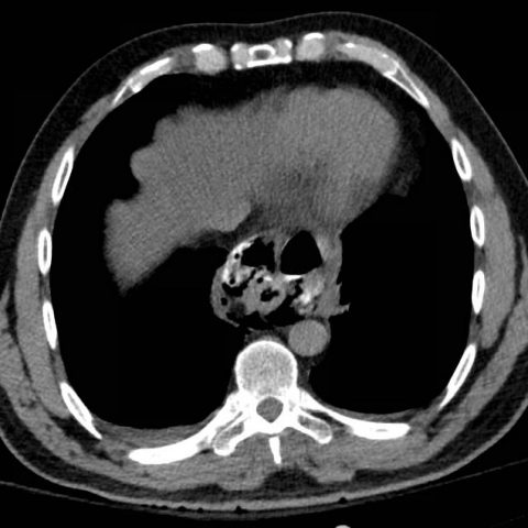 Esophageal Perforation - JETem