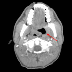 Oropharynx Ulceration - JETem