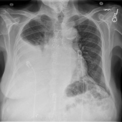 Re-expansion Pulmonary Edema - JETem