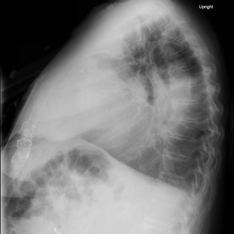 Re-expansion Pulmonary Edema - JETem