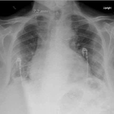 Re-expansion Pulmonary Edema - JETem