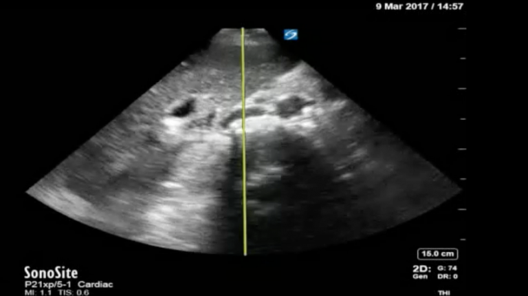 Using Bedside Ultrasound to Rapidly Differentiate Shock – JETem