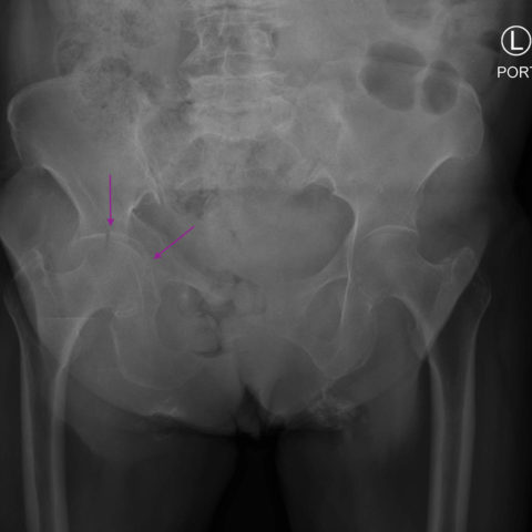 Acetabular Fracture - JETem