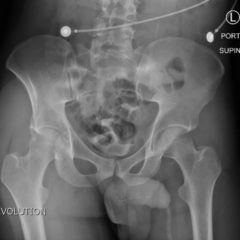 Bilateral Hip Dislocation in Unrestrained Driver - JETem