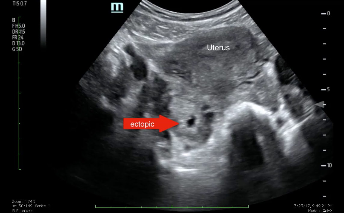 Will Ectopic Pregnancy Show On Test