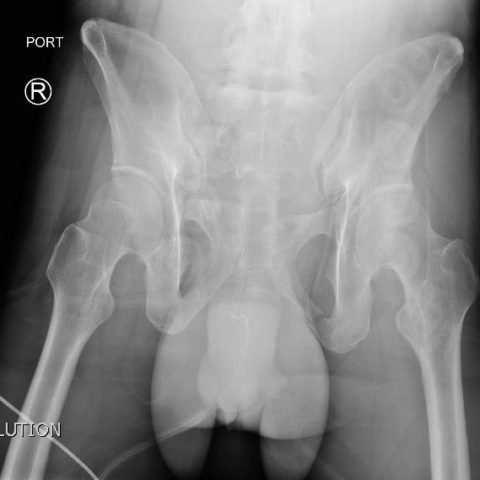 Open Book Pelvic Fracture 1, Xray. JETem 2017 - JETem