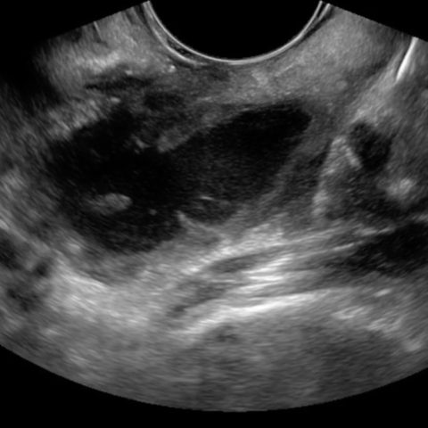 Bilateral Hip Dislocation in Unrestrained Driver - JETem