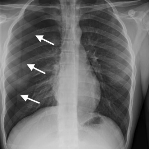 Spontaneous Pneumothorax - JETem