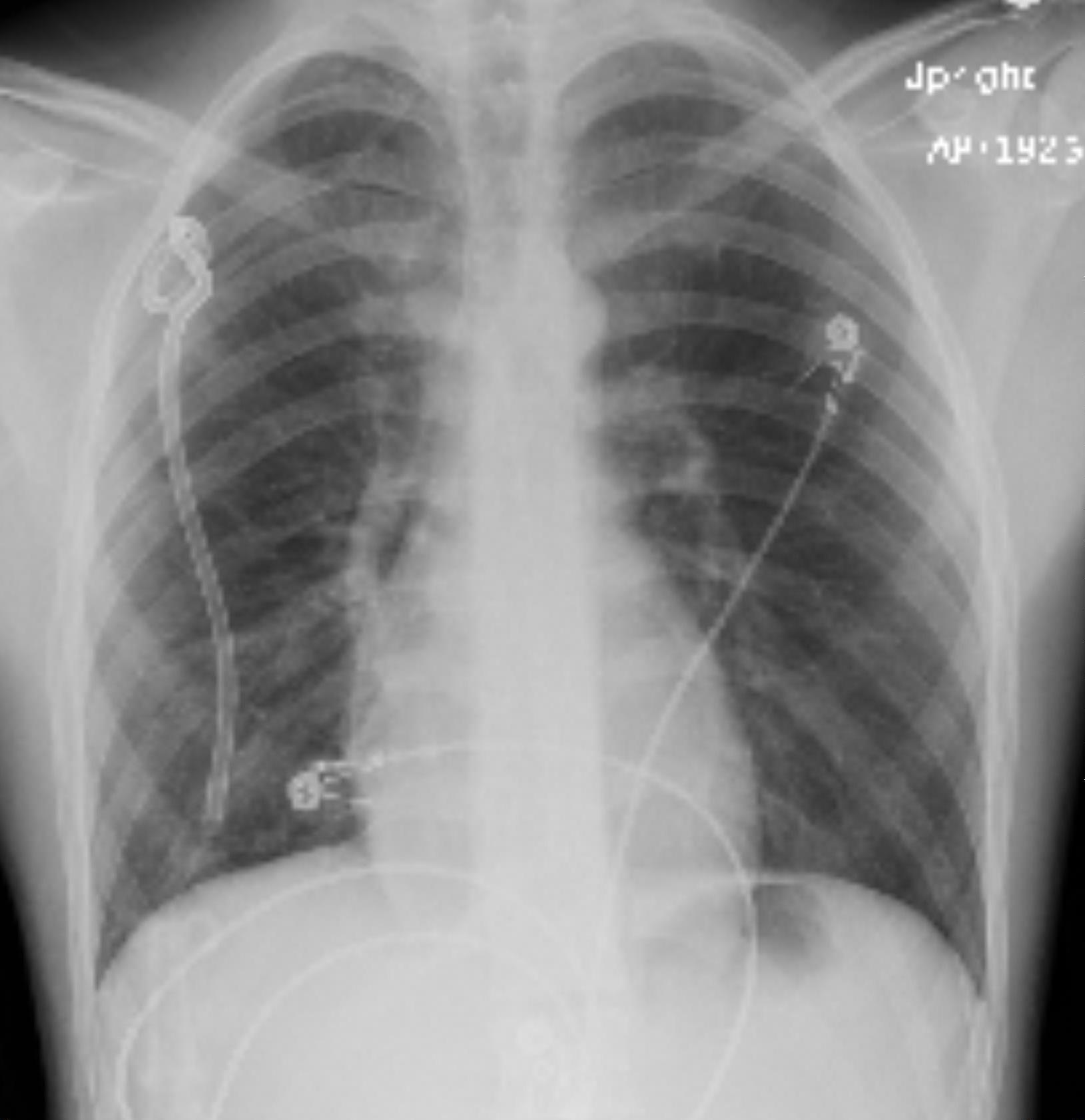 spontaneous pneumothorax chest tube