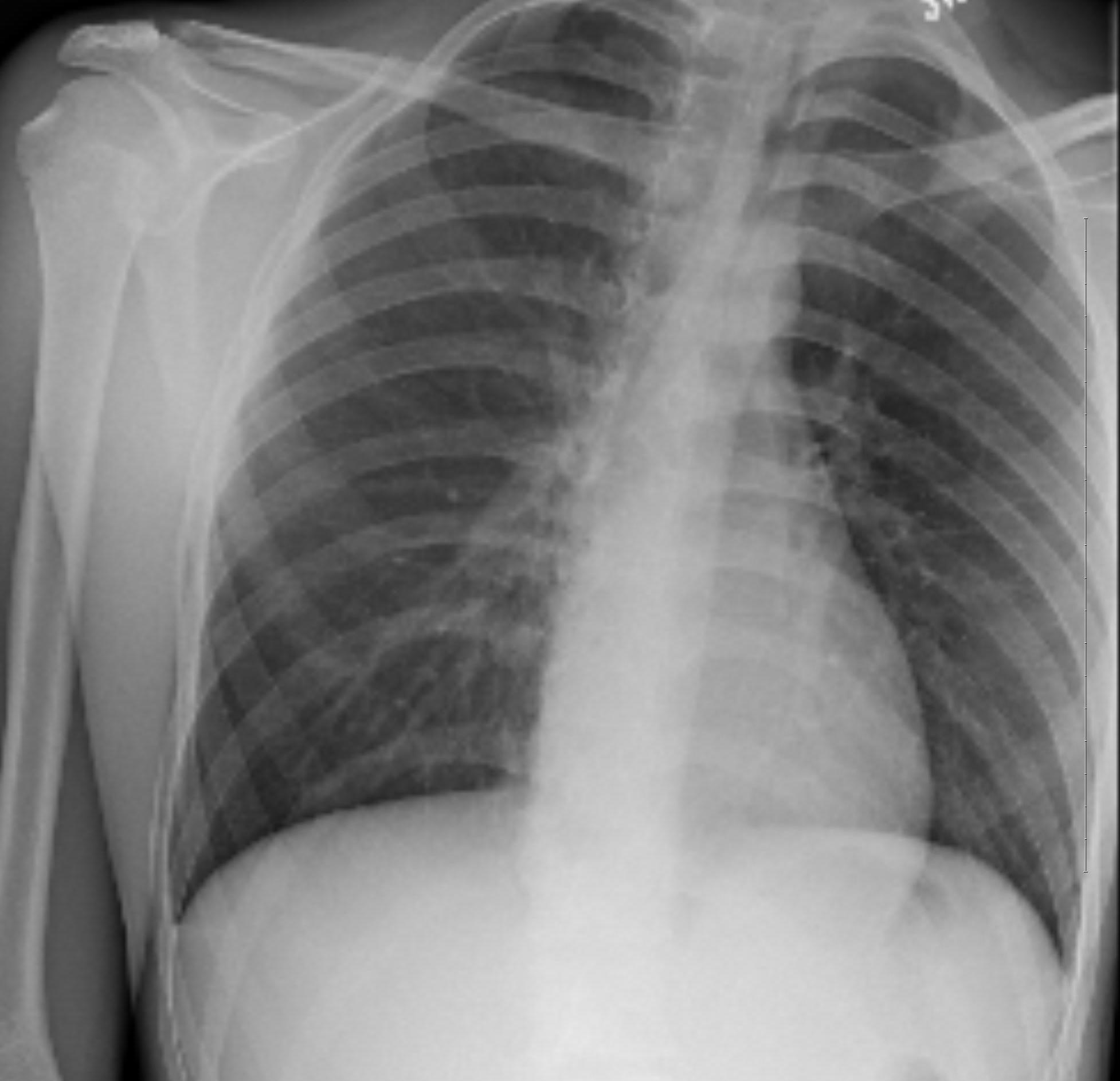 Spontaneous Pneumothorax 3, resolved, XR. JETem 2017 - JETem