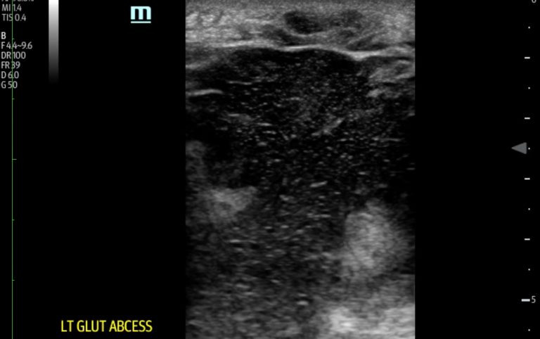 Gluteal Abscess, Ultrasound. JETem 2018 - JETem