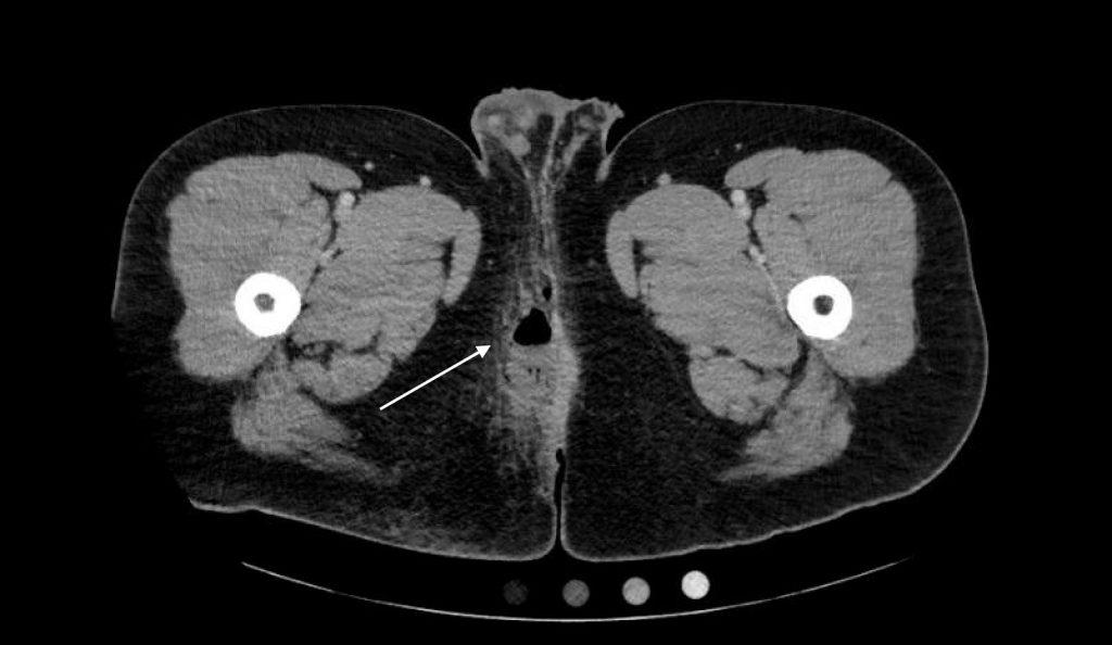 Perianal Abscess Axial Ct Annotated Jetem 2018 Jetem