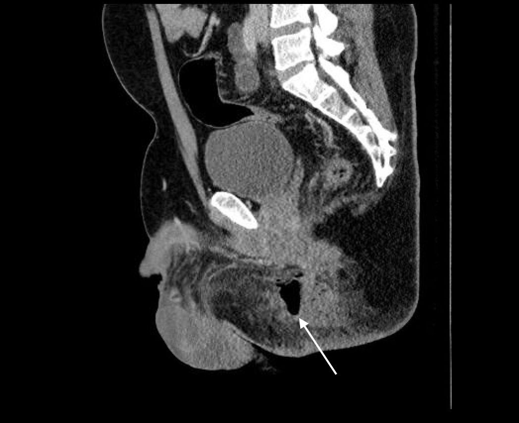 perirectal abscess