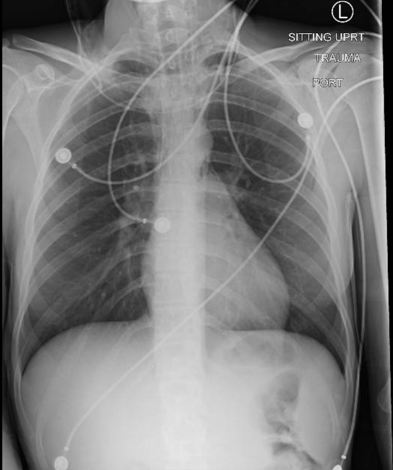 Pneumomediastinum, CXR AP. JETem 2018 - JETem