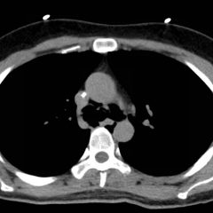 Spontaneous Pneumomediastinum: Hamman Syndrome - Jetem