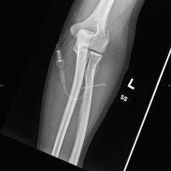 Lateral Epicondyle Fracture - JETem