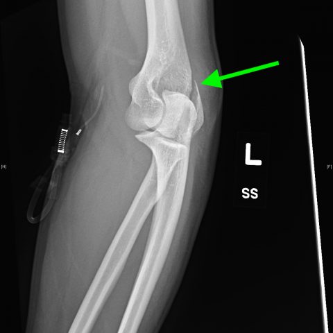 Lateral Epicondyle Fracture - JETem