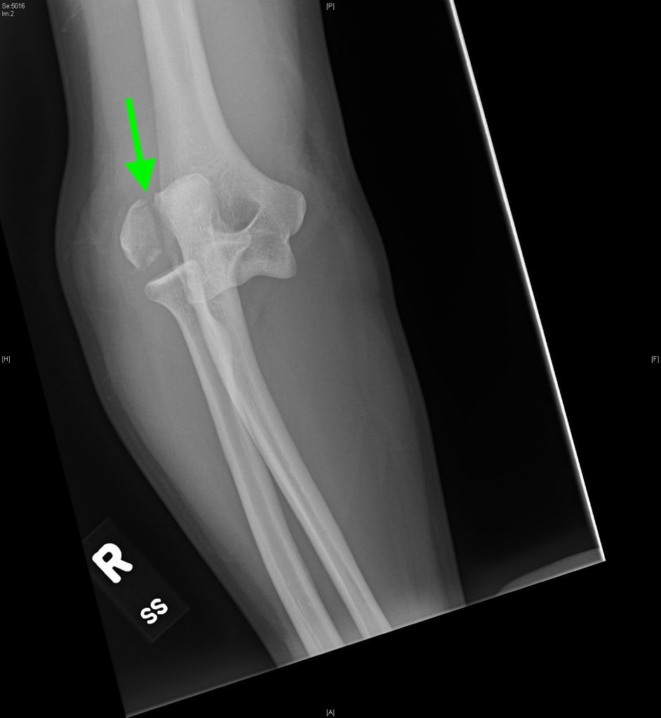 Lateral Epicondyle Fracture, Right Elbow AP XR, Annotated. JETem 2018 ...