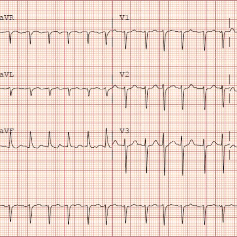 Chest Pain With Acute Coronary Syndrome - Jetem