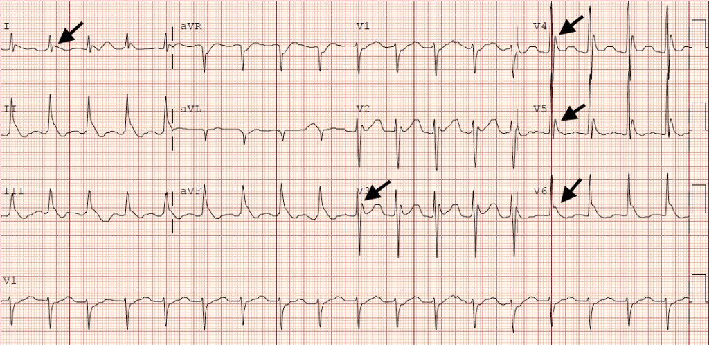 Osborn Waves in a Severely Hypothermic Patient - JETem