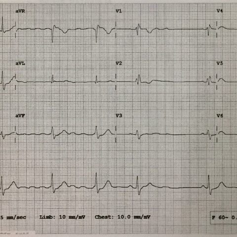 Propafenone Overdose-induced Arrhythmia and Subsequent Correction After ...