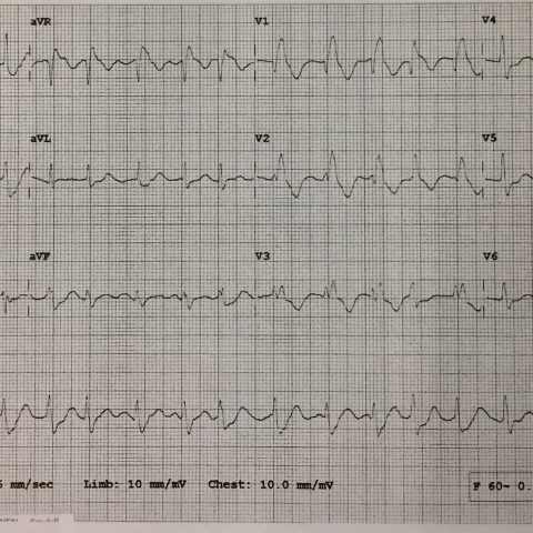 Propafenone Overdose-induced Arrhythmia and Subsequent Correction After ...