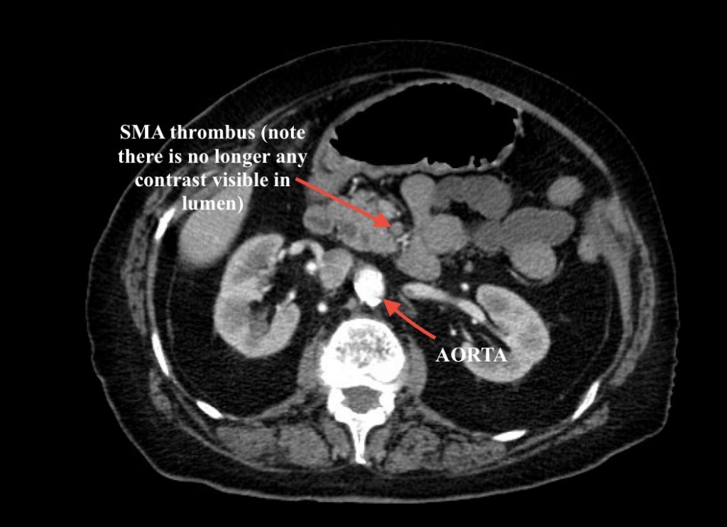 superior-mesenteric-artery-axial-ct-annotated-jetem-2018-jetem