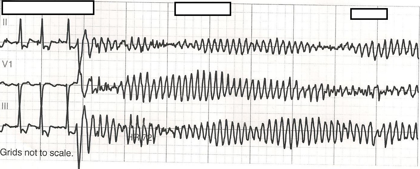 Torsades de Pointes - JETem