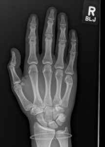 3 R Hand Metacarpal Fracture Dislocation, Post-Reduction. Radiograph ...