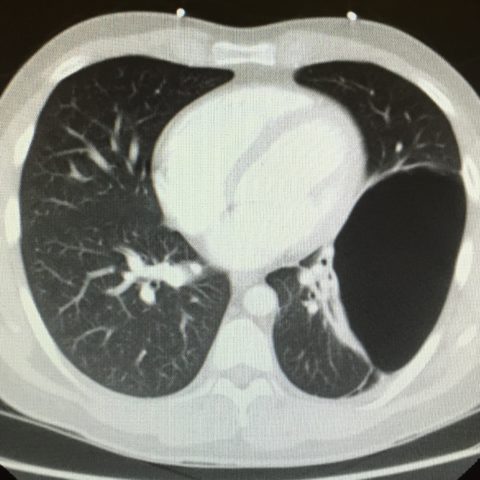 Bullous Emphysema - JETem