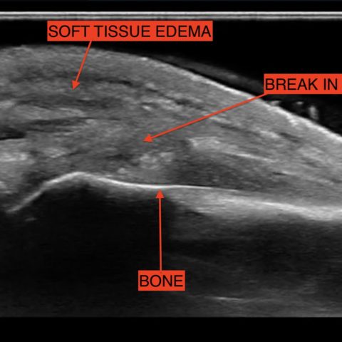 The Role Of Chest X-Ray And Bedside Ultrasound In Diagnosing Pulmonary ...