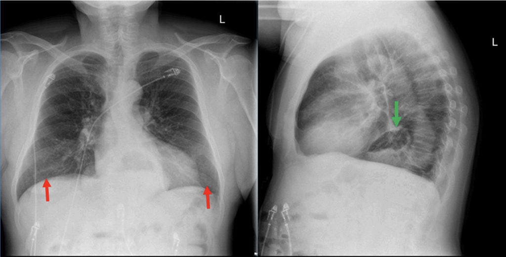 Incidental Hiatal Hernia on Chest X-ray - JETem