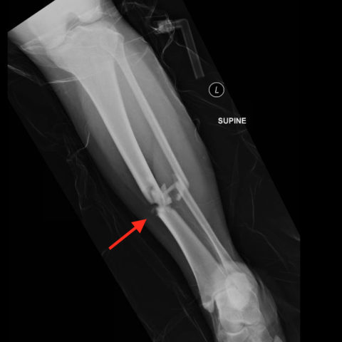 Bilateral Tibia/Fibula Fractures in Automobile versus Pedestrian ...