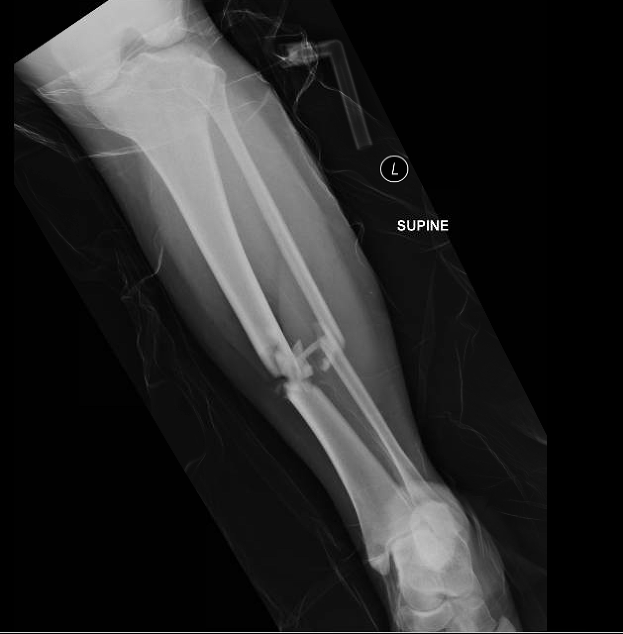 compound fracture x ray