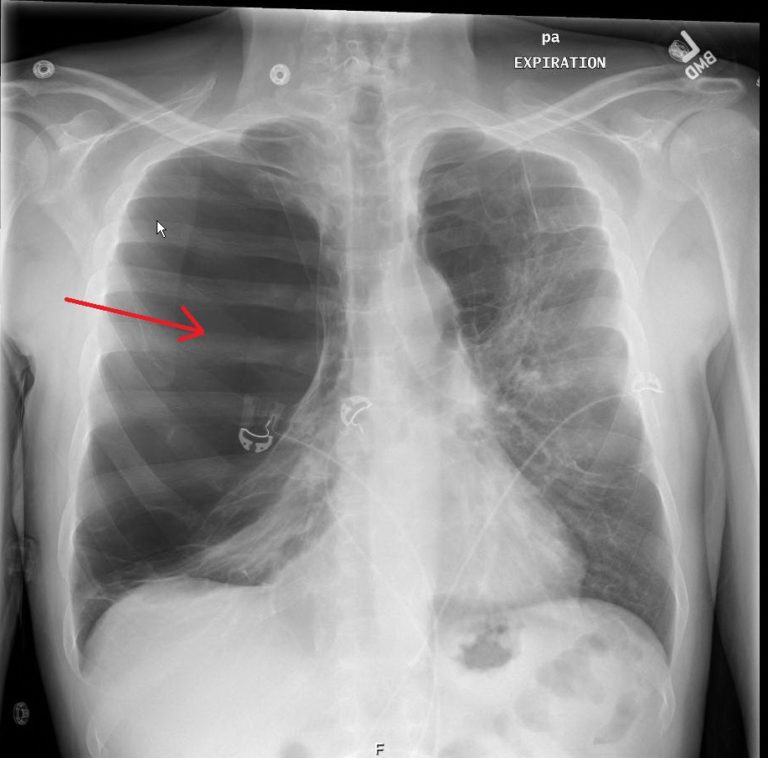 Pulmonary Bleb vs Ptx CXR AP. JETem 2018 - JETem