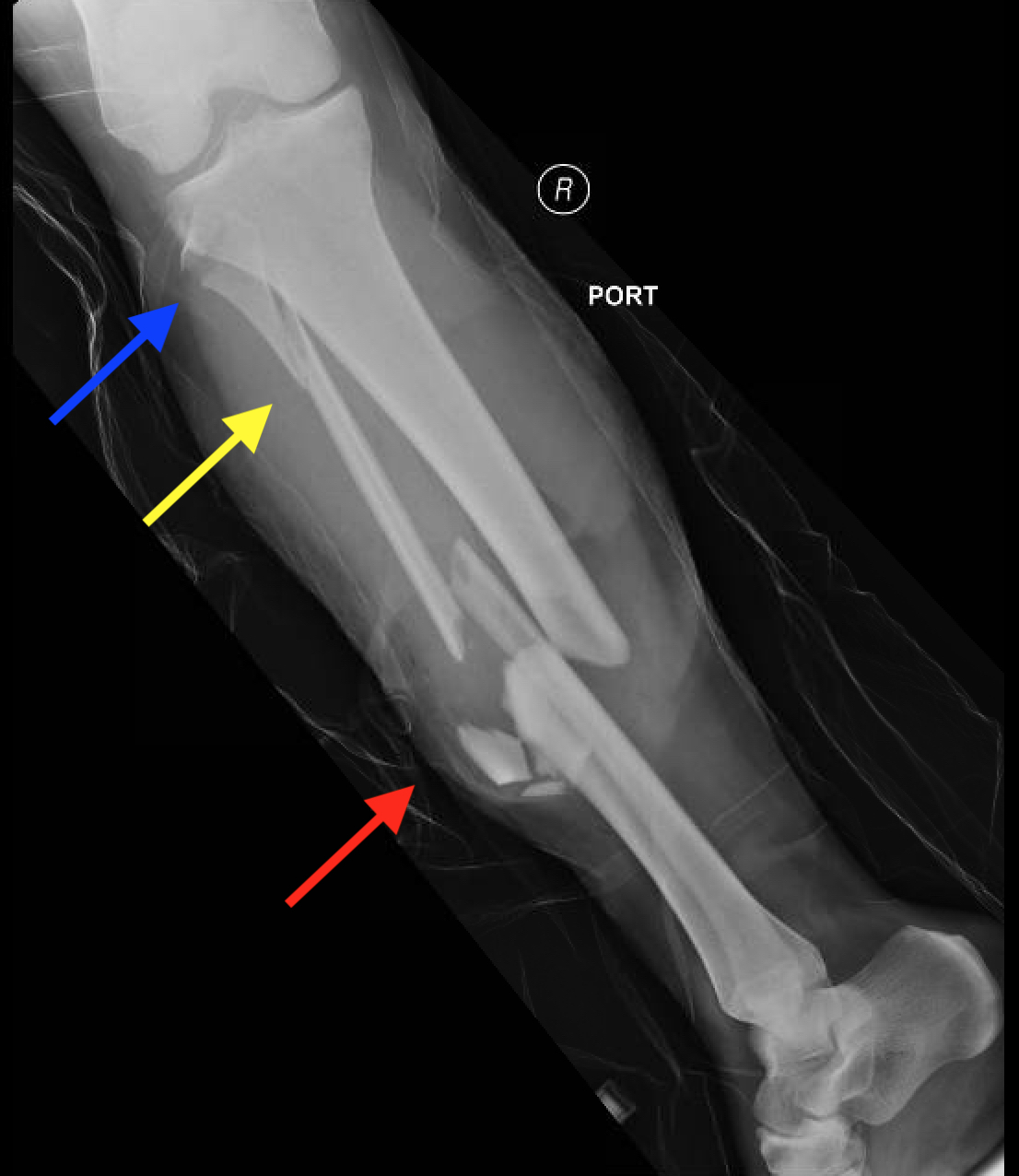 tibia and fibula fracture
