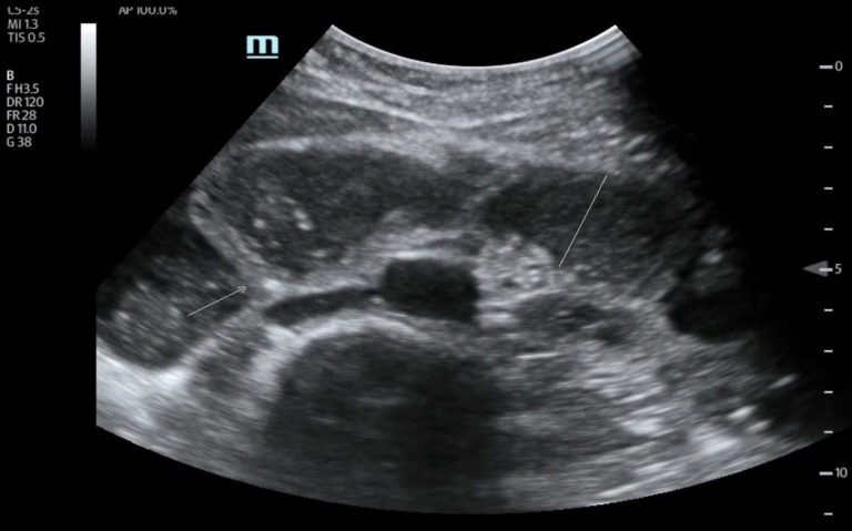 Point Of Care Ultrasound Illustrating Small Bowel Obstruction - JETem