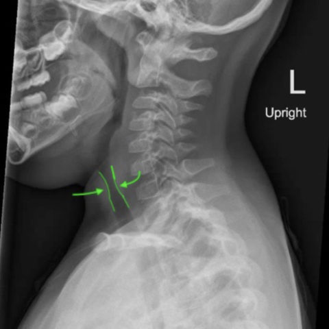 Croup - JETem