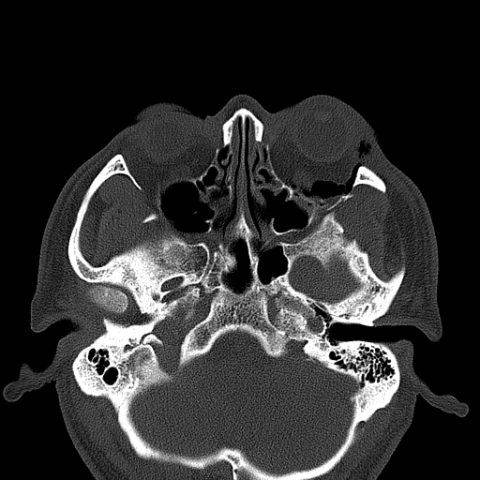 Facial Fracture Induced Periorbital Emphysema - JETem