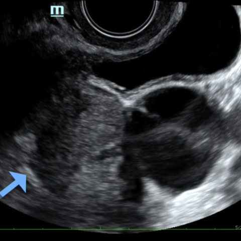 Point-of-care Ultrasound for the Diagnosis of Ovarian and Fallopian ...