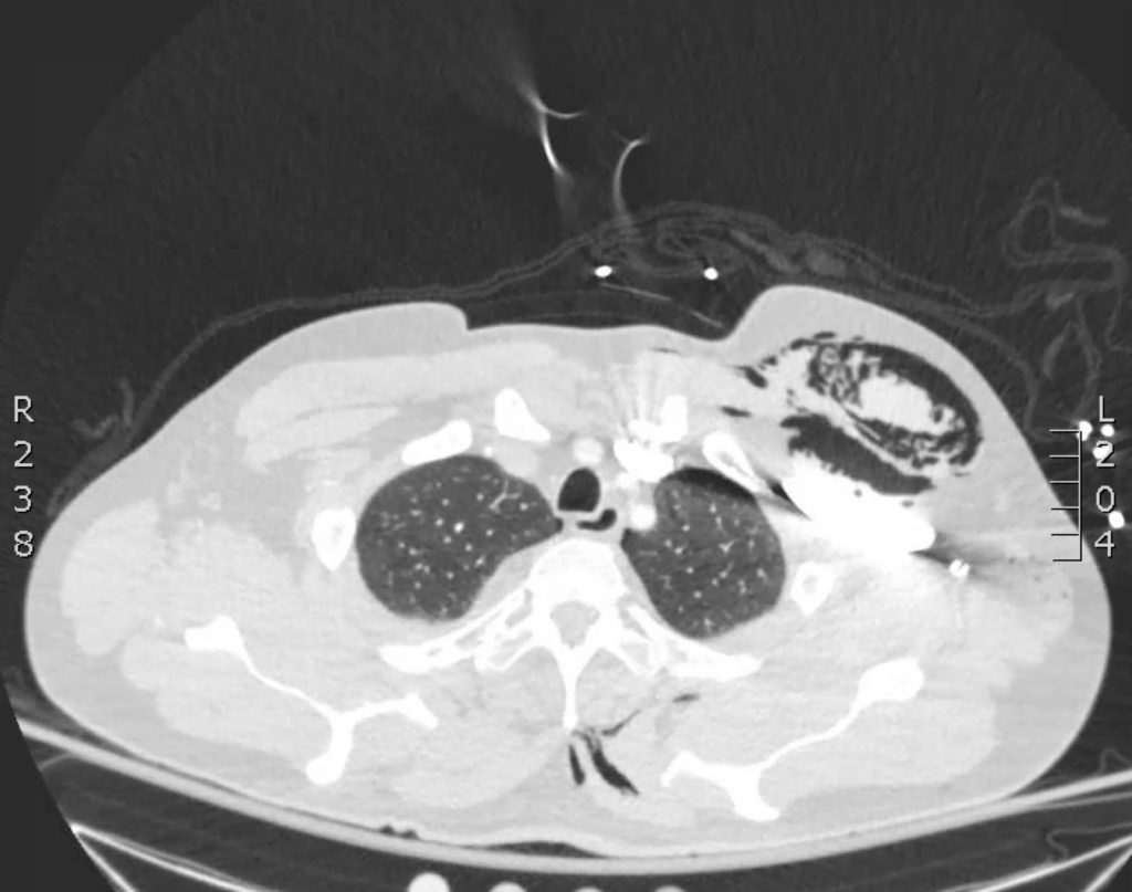 Subcutaneous Emphysema Axial Ct Jetem Jetem