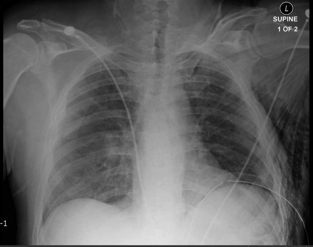 Subcutaneous Emphysema. CXR 2, Post Left Chest Tube 2. JETem 2018 - JETem