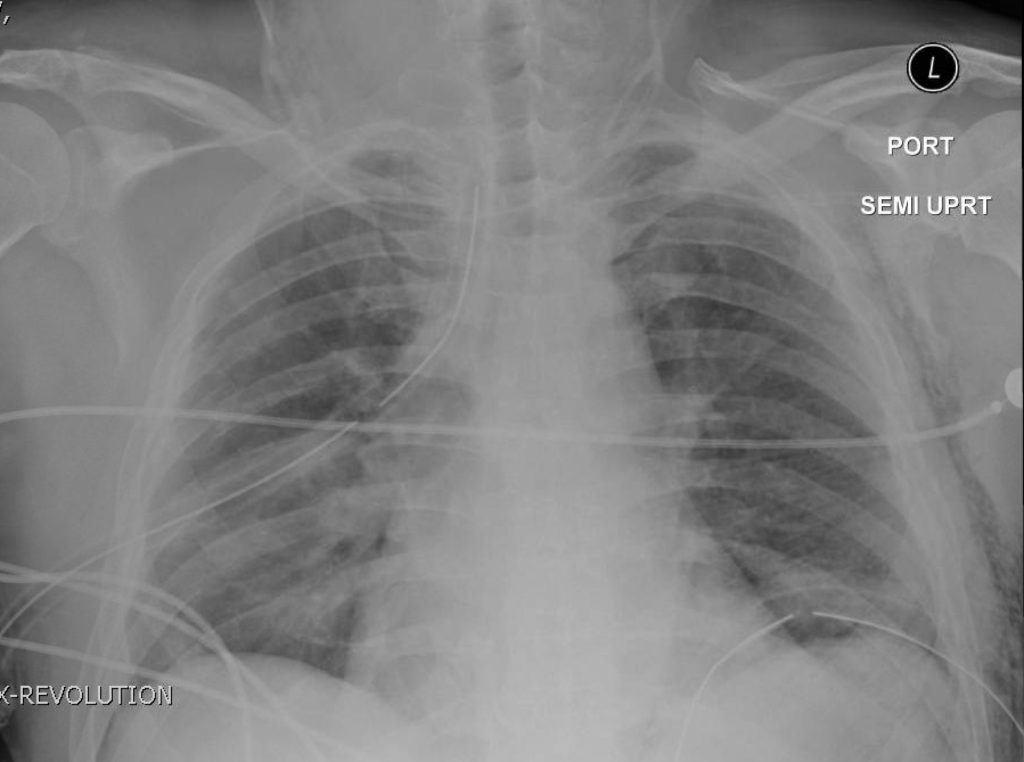 Subcutaneous Emphysema. CXR, Post Bilateral Chest Tubes. JETem 2018 - JETem