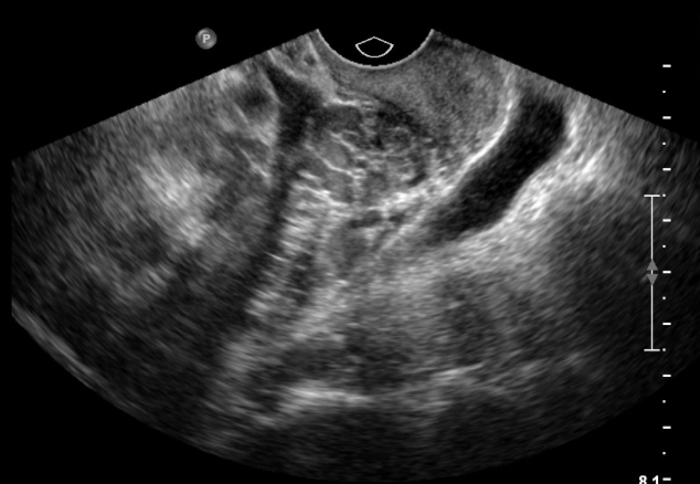 Ovarian Teratoma JETem Ovarian Teratoma JETem