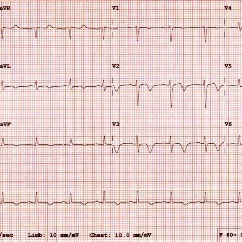 Guilty as Charged: Jailed Coronary Vessel Presenting as Wellens ...