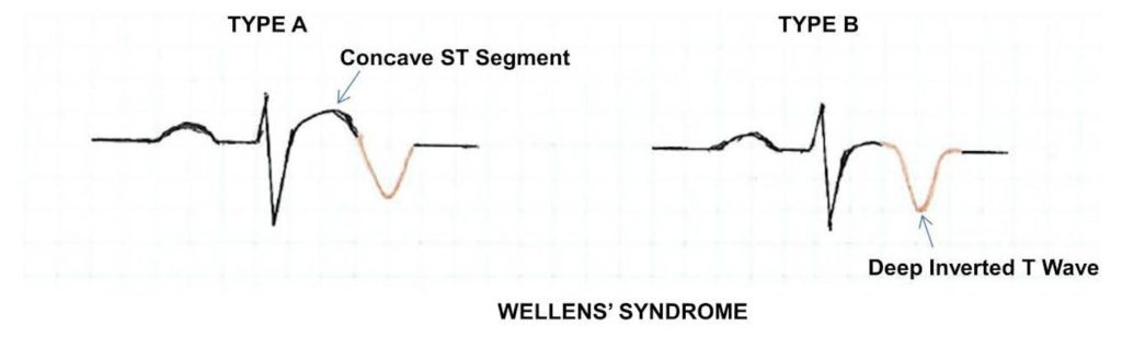 Wellens' Syndrome ECG. Type A vs Type B. JETem 2019 - JETem