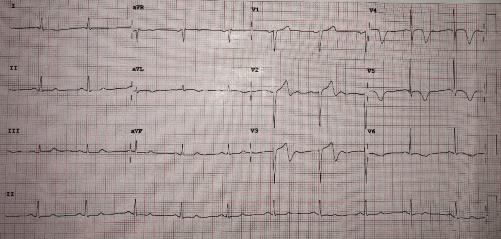 Wellens’ Syndrome - JETem